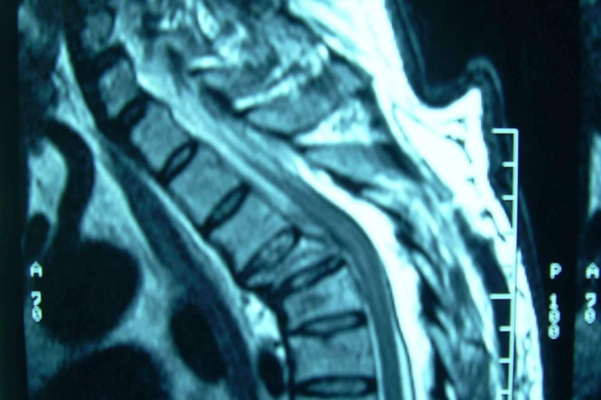 Neurocirugía Galarza sobre las fracturas vertebrales