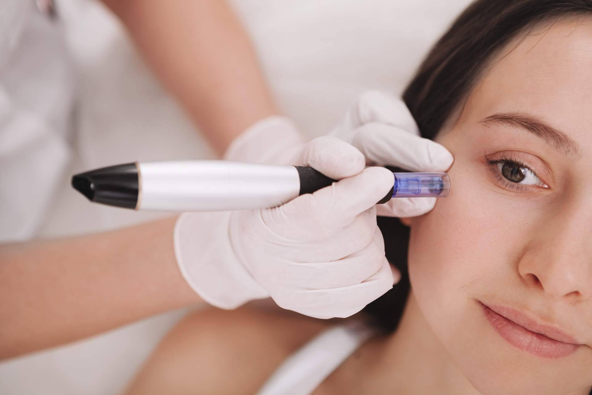 Eliminar pequeñas cicatrices y mejorar el aspecto de la piel con dermapen de G&G Beauty en ojeras y en cicatrices