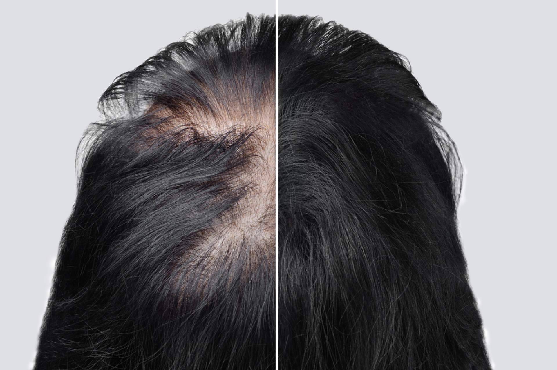 Saw Palmetto brinda tratamientos para la alopecia androgénica