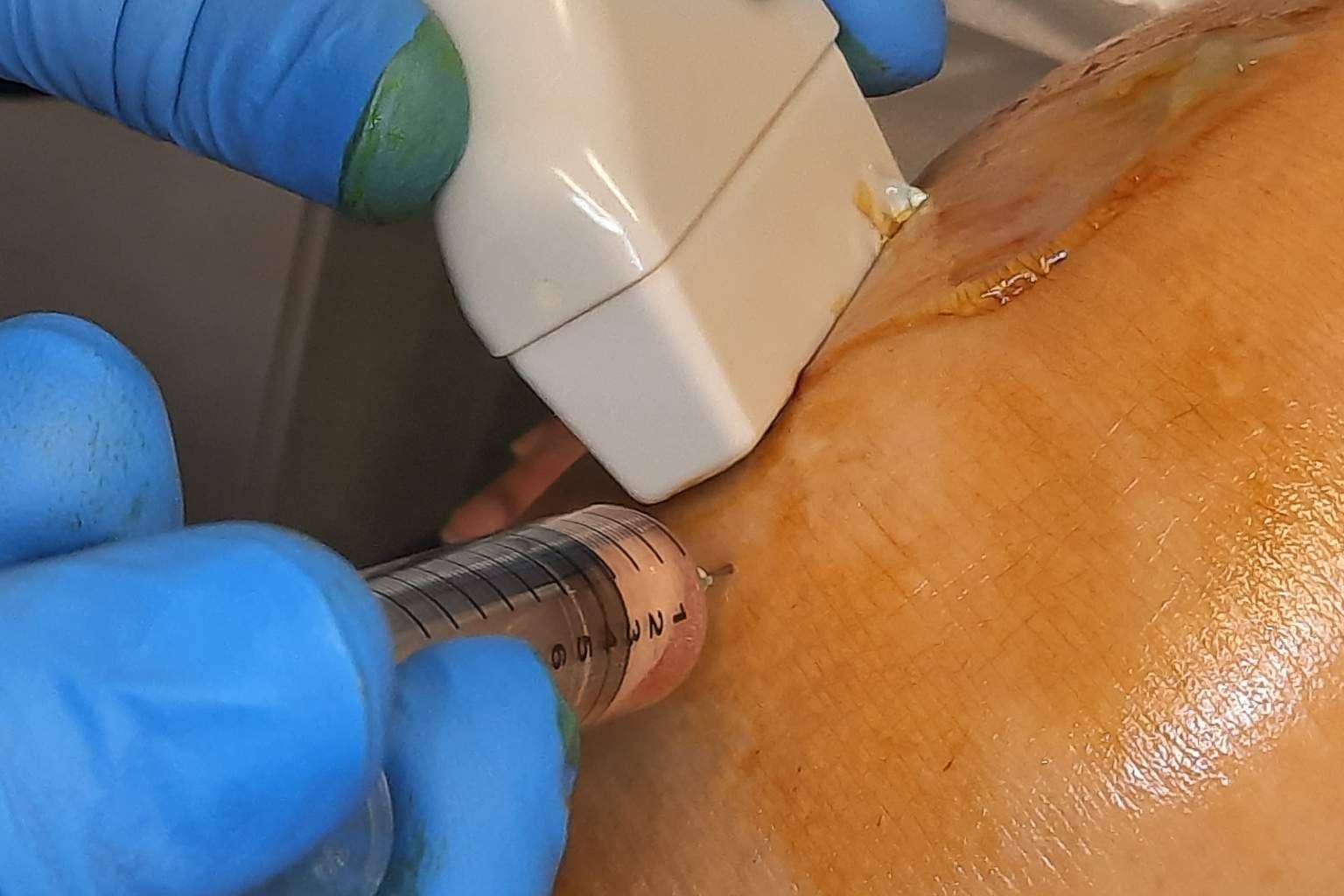 Tratar la artrosis de rodilla de manera eficaz sin cirugía a través de las infiltraciones de plasma rico en plaquetas y células madre
