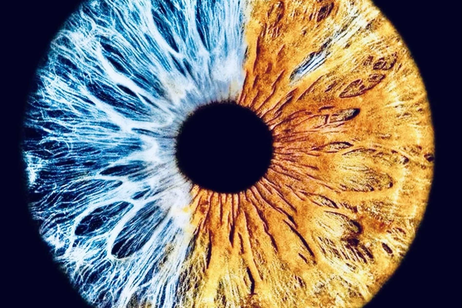 Eyecos habla sobre las heterocromías congénitas