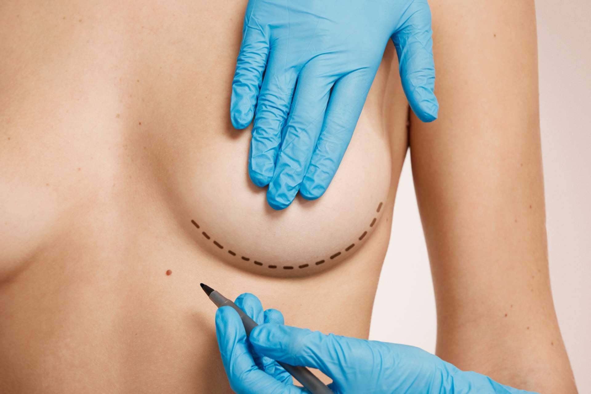 Clínicas Beauty&Beauty, un referente en corrección de mamas tuberosas