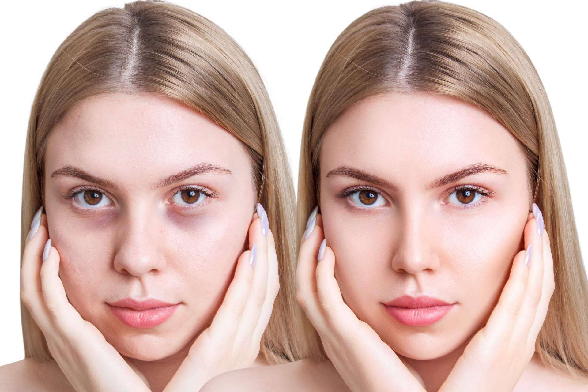 Combatir las ojeras con ácido hialurónico; el tratamiento no invasivo de Centro Estética El Pilar