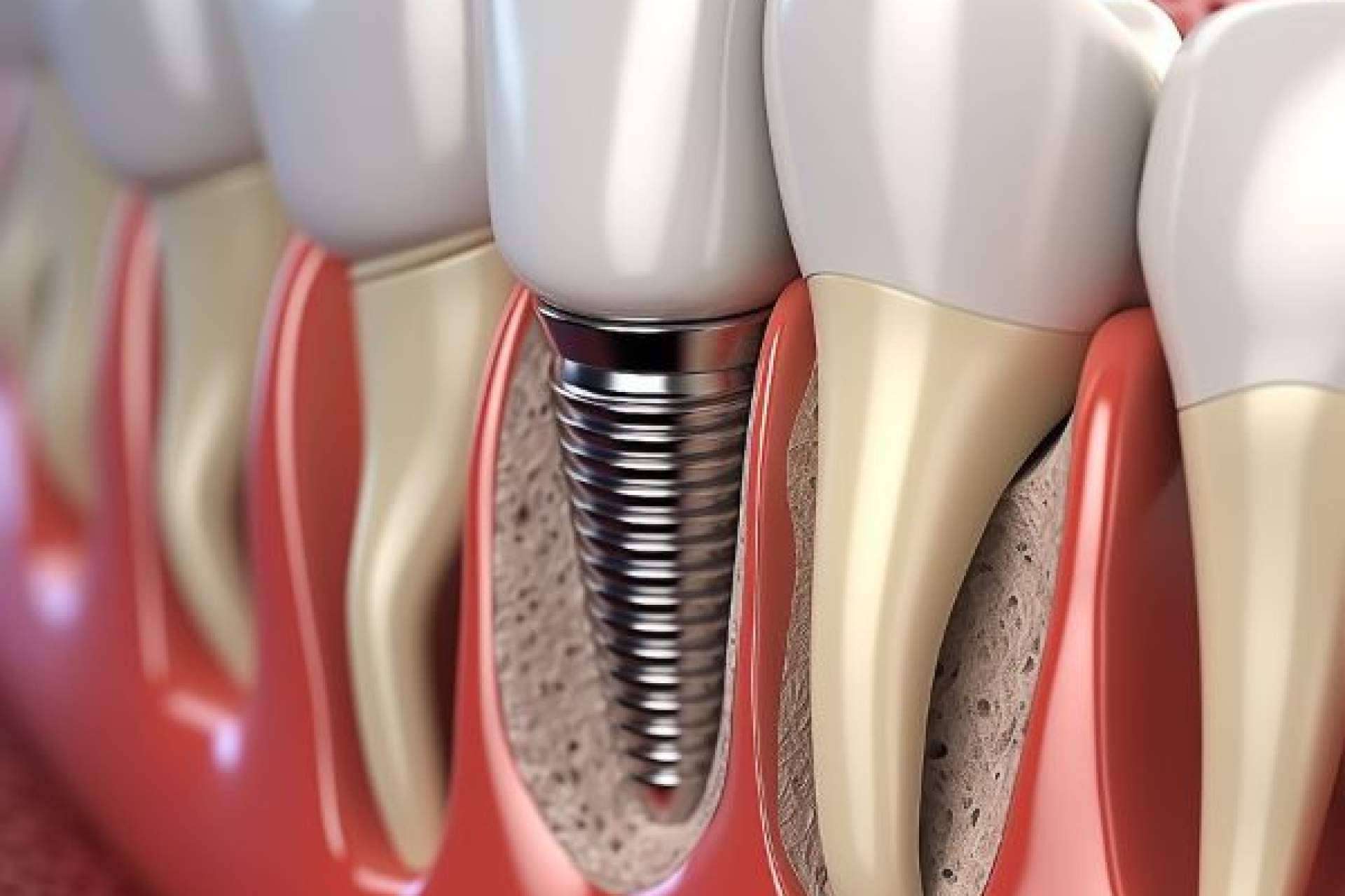 Denty Dent en Madrid presenta el estándar de calidad en implantes dentales