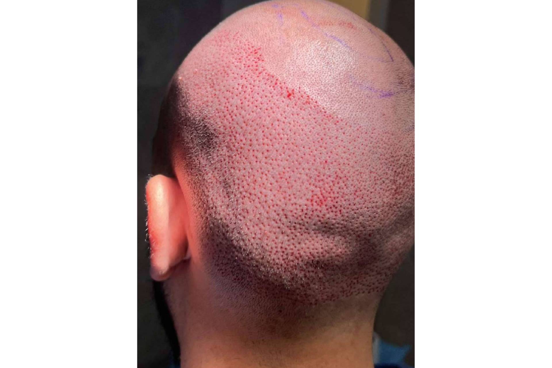 Chara Capilar en Barcelona ofrece los tratamientos más innovadores para la alopecia