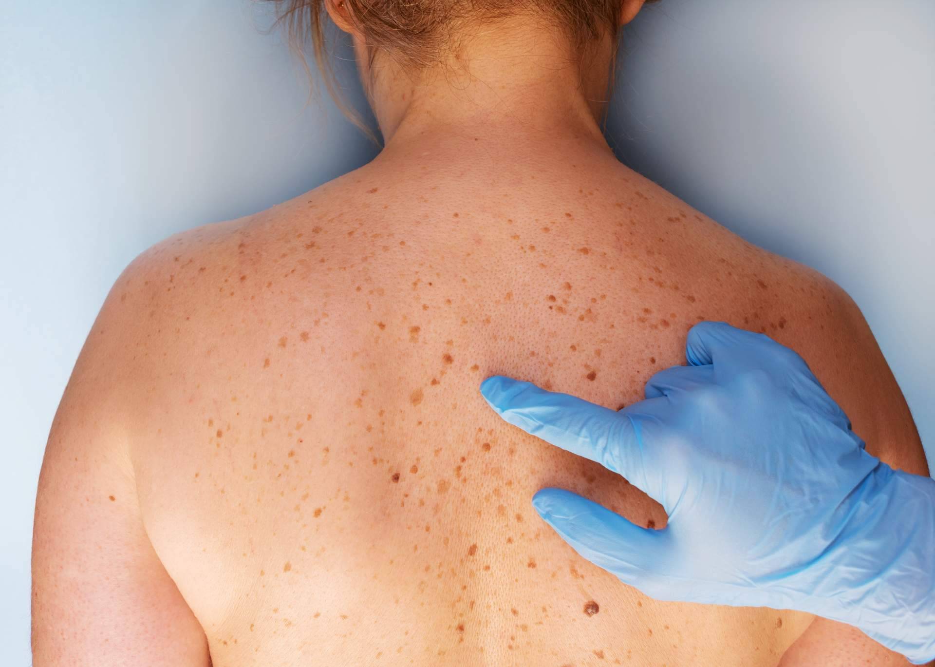 El Centro Estética el Pilar ofrece tratamientos para la eliminación de manchas en la piel en Madrid