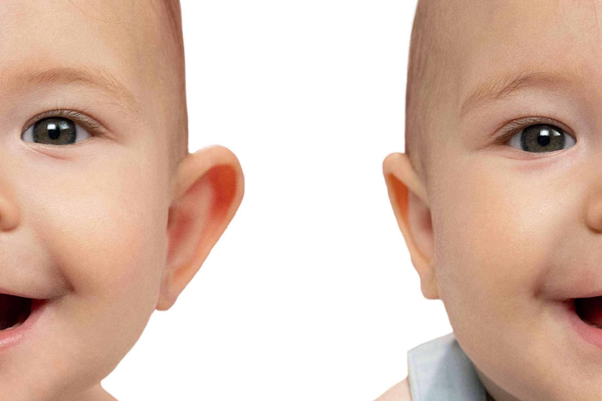 Otostick Bebé, el producto español que corrige las orejas de soplillo en bebés y niños