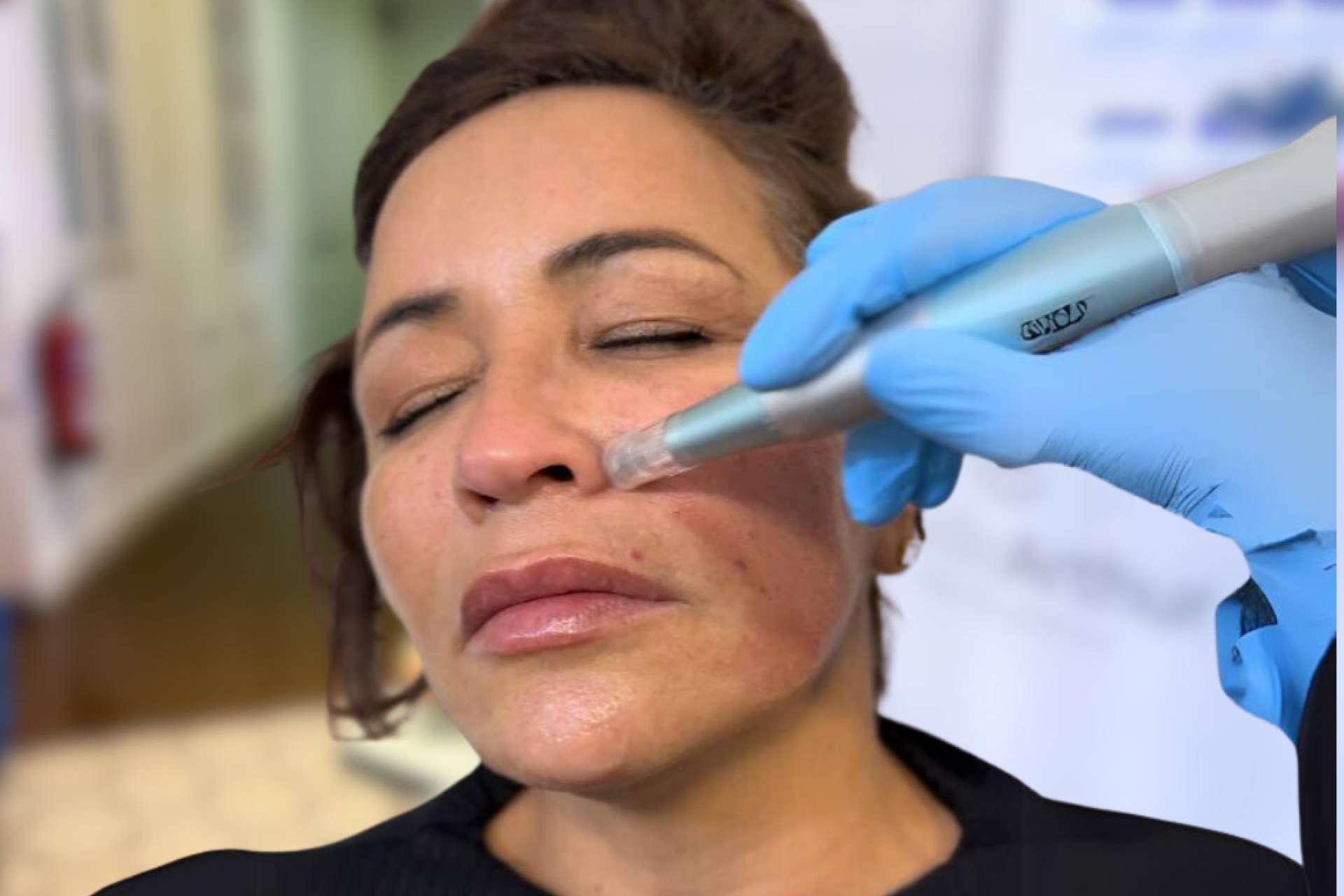 Renovar las piel post-verano con los tratamientos reparadores faciales de la clínica Cecilia Arthur