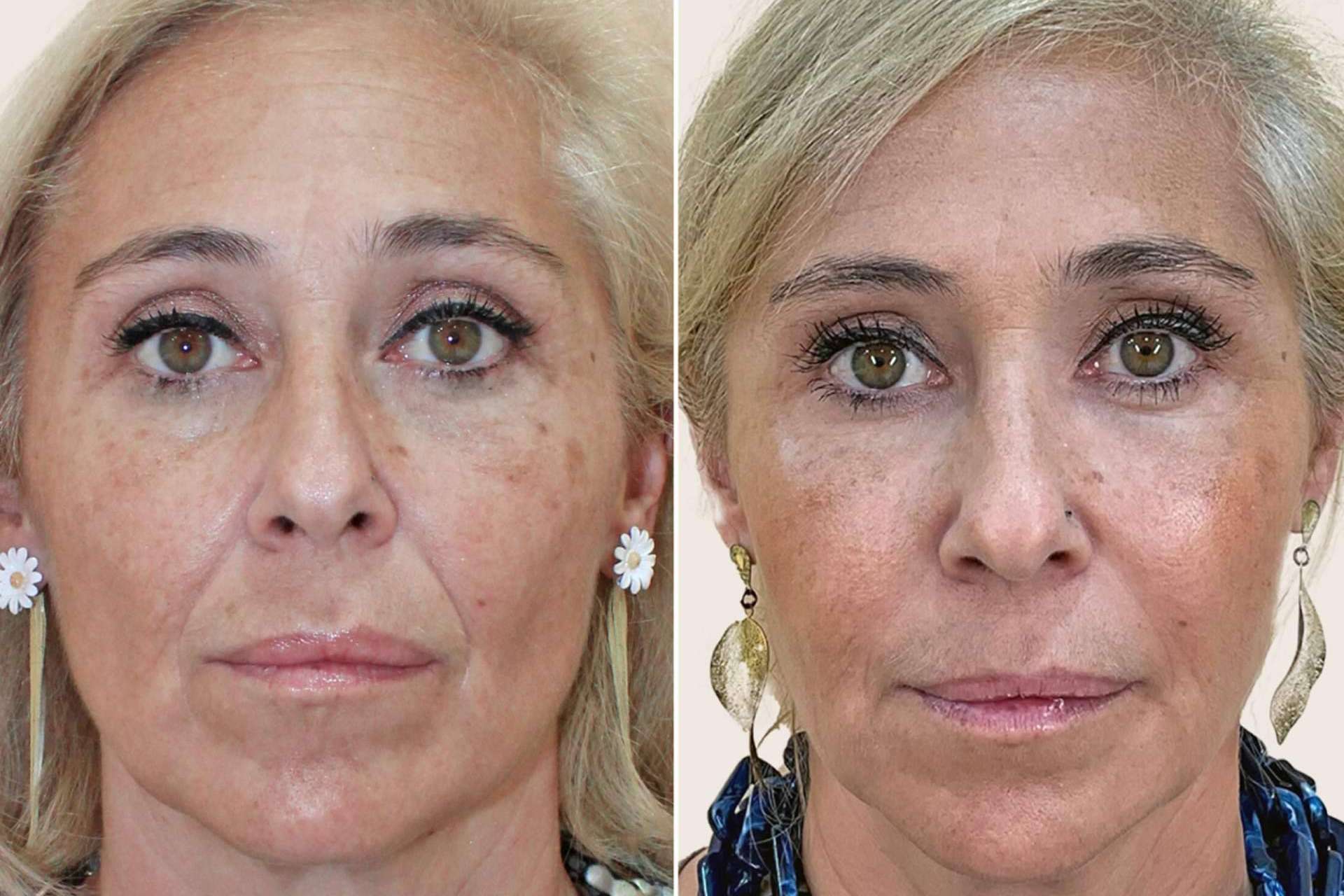 Más allá de los inductores; la clave para unos rasgos más armónicos a cualquier edad