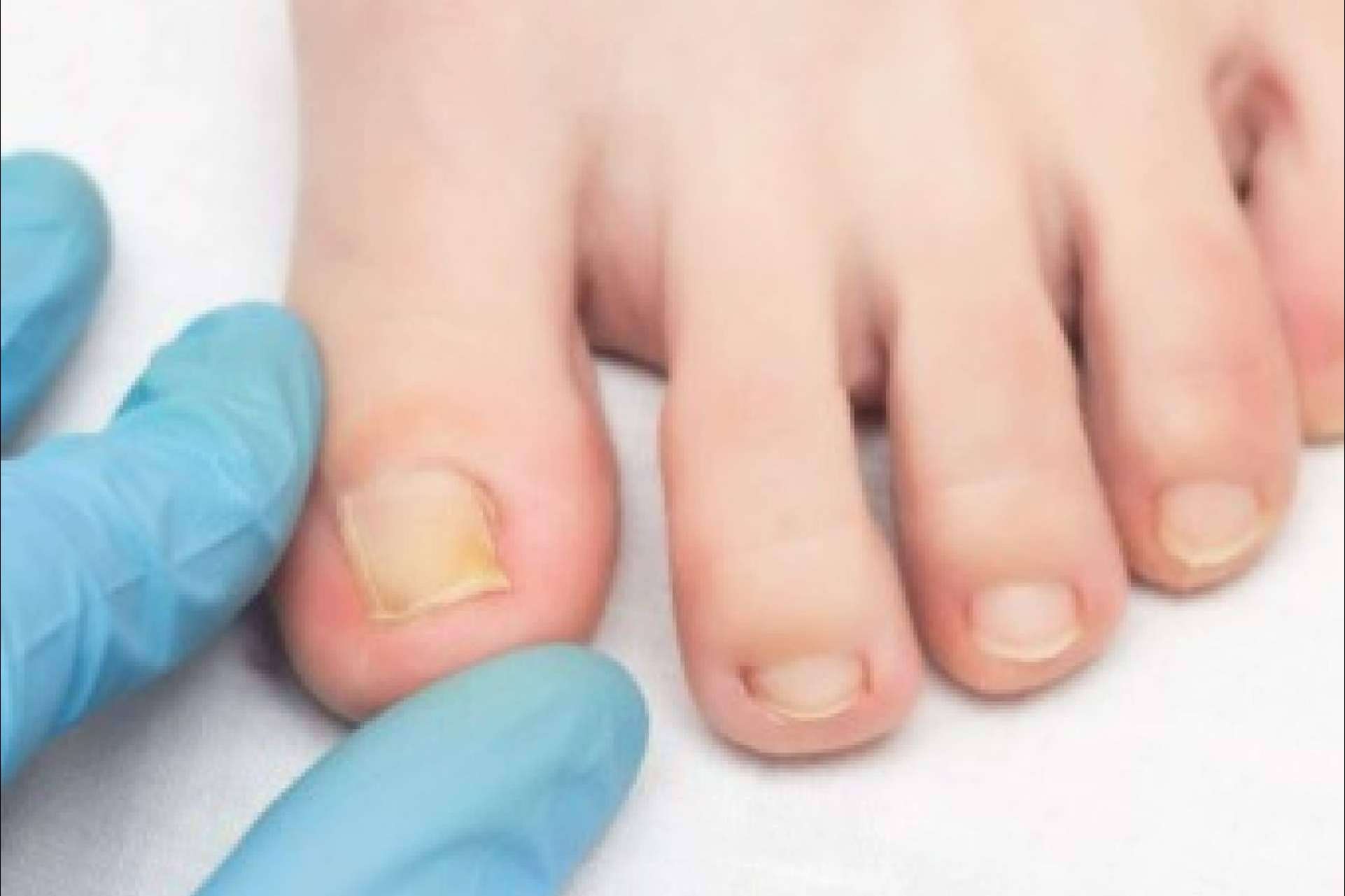 Micosis cutáneas; cómo prevenir los hongos en la piel durante el verano