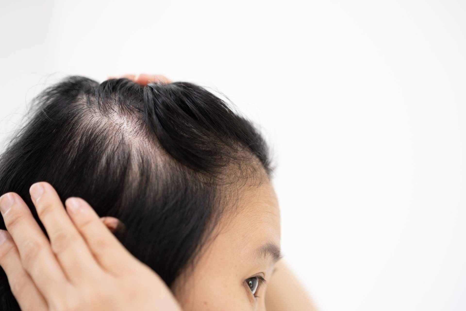 Estrés y cabello; el impacto emocional en la salud capilar