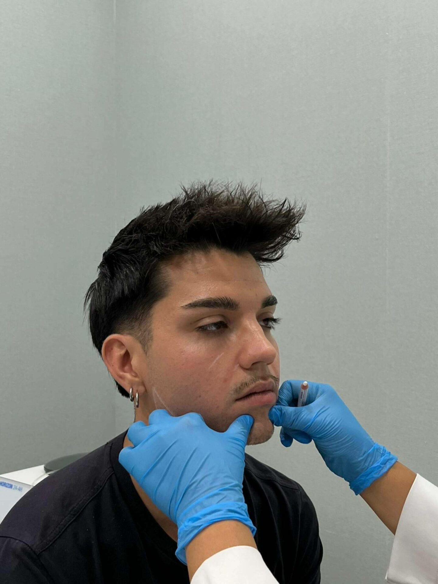 Rejuvenecimiento facial integral; la sinergia entre ácido hialurónico y tratamientos antiarrugas en medicina estética