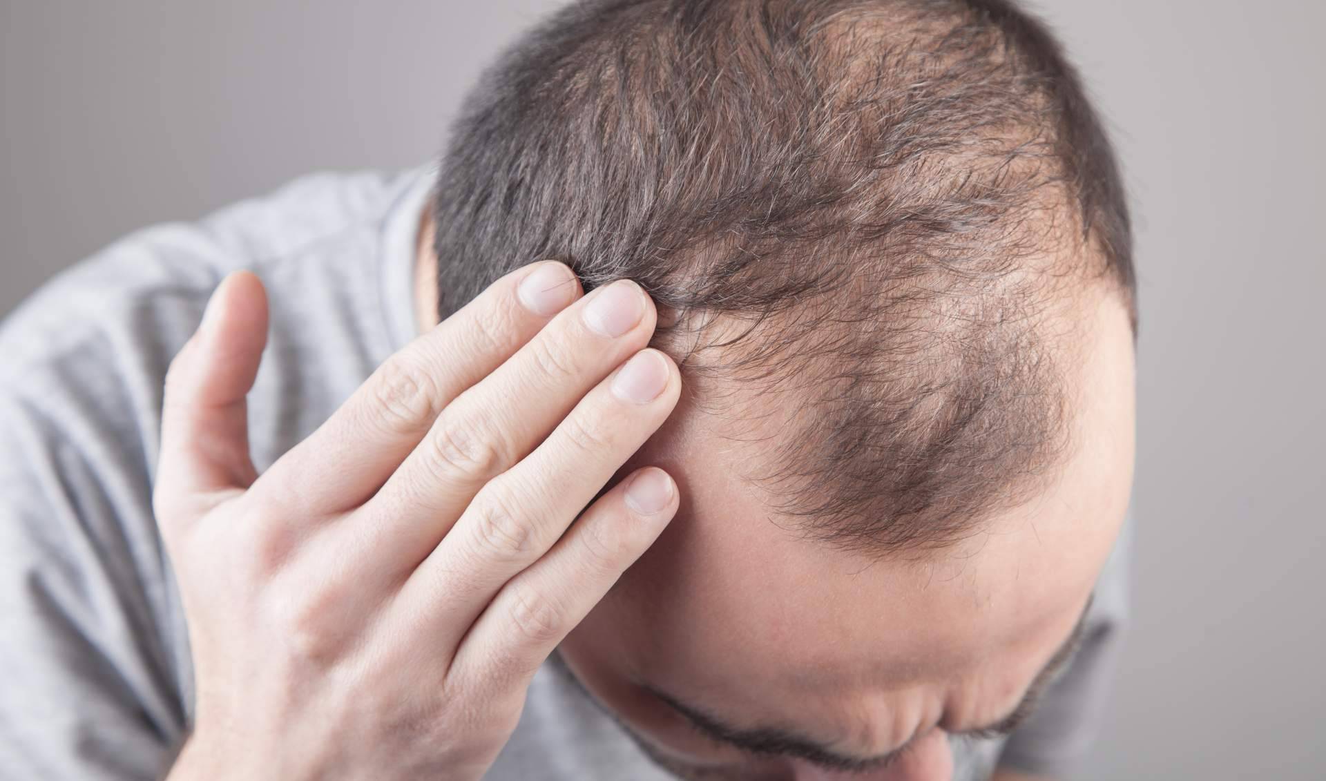 Xpecia Hombre, el suplemento que frena la caída del cabello y refuerza su crecimiento desde el interior