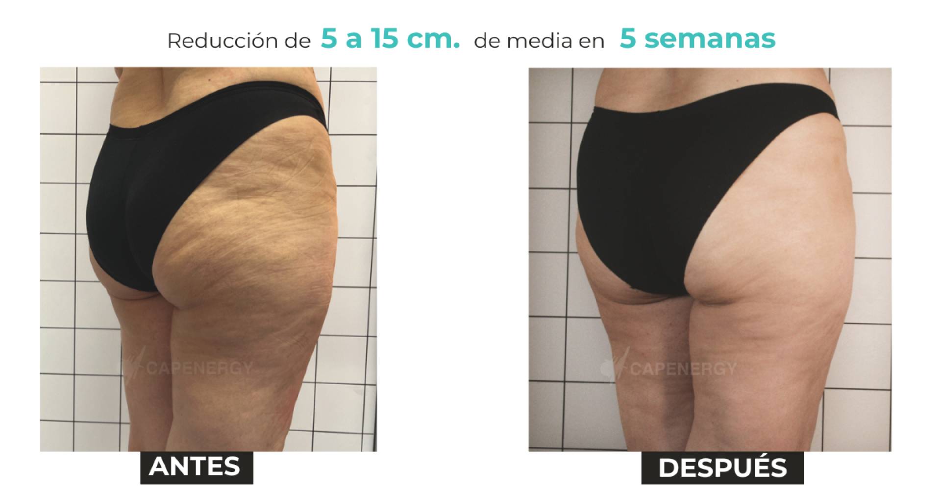 Capenergy logra 14,8 cm de reducción en celulitis en estudio clínico